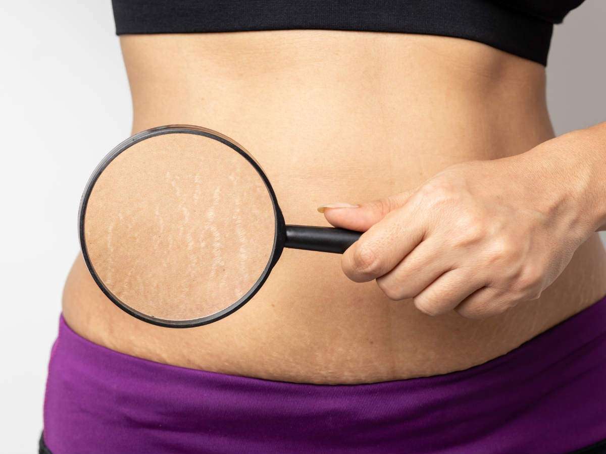 Leia mais sobre o artigo Ganho de peso e estrias: causas e como tratar