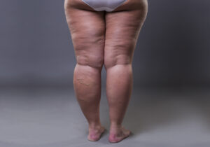 lipedema o que é tratamento causas sintomas estágios