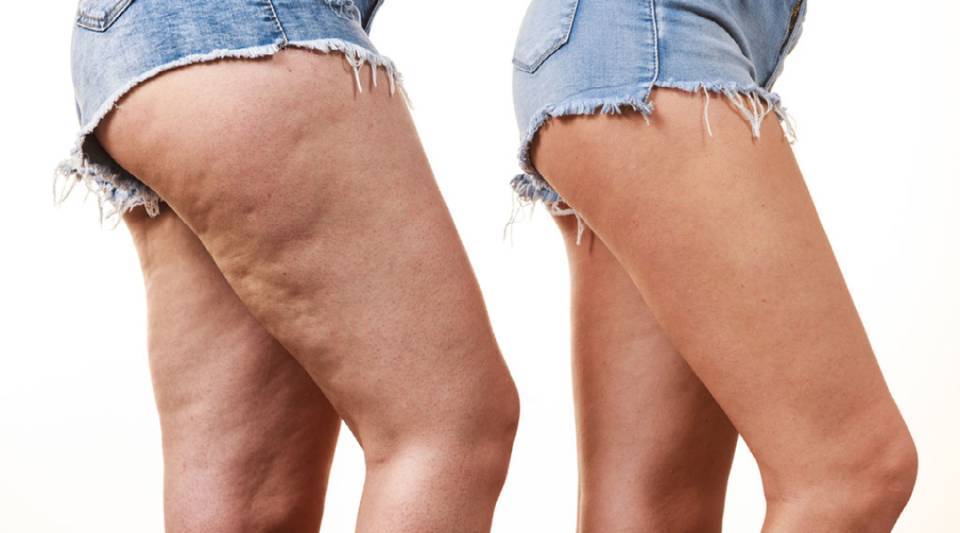 lipedema o que é causas tratamento estágios